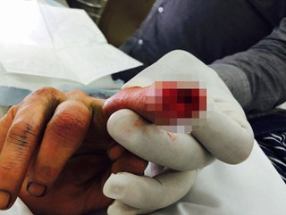 Окровавленная рука Джонни Деппа на фото из амбулаторной.